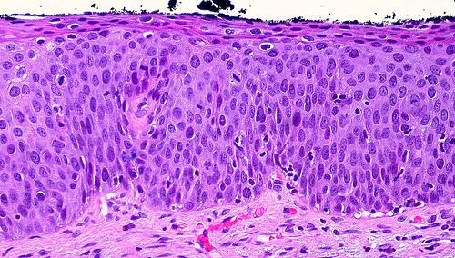Sel epitel skuamosa: karakteristik dan penyakit