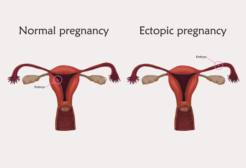 Kehamilan Normal dan Kehamilan Ektopik