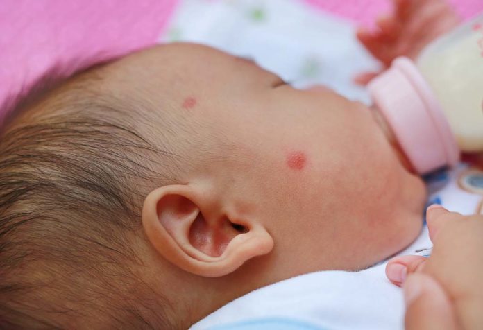 Alergi Protein Susu Sapi (CMPA) pada Bayi, Gejalanya, dan Cara Mengatasinya