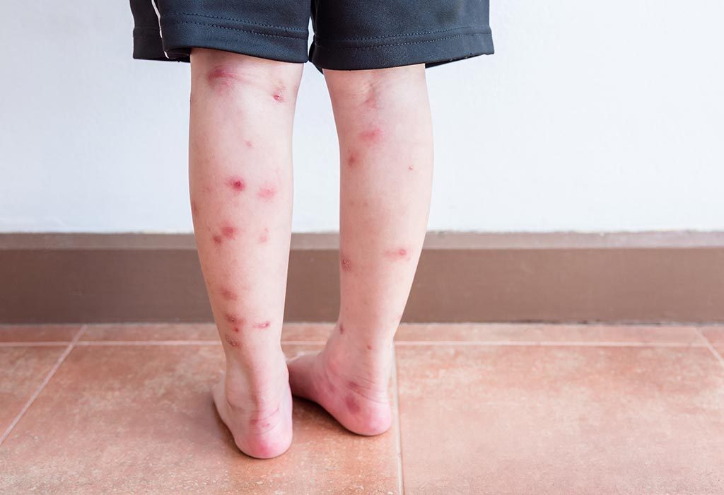 Seorang anak dengan bekas luka di kakinya