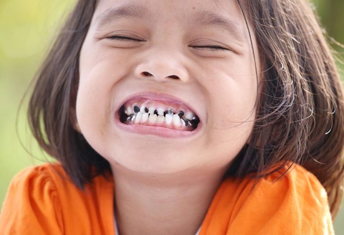 Gigi Patah pada Anak - Penyebab, Pengobatan, dan Pencegahannya