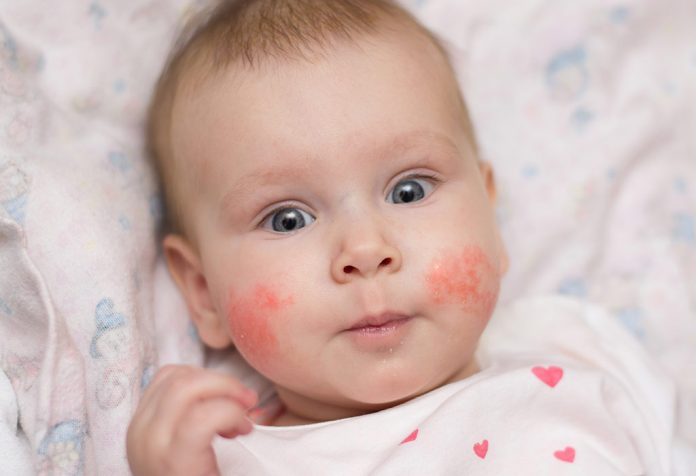 Semua Tentang Slapped Cheek Syndrome (Penyakit Kelima) pada Bayi dan Balita