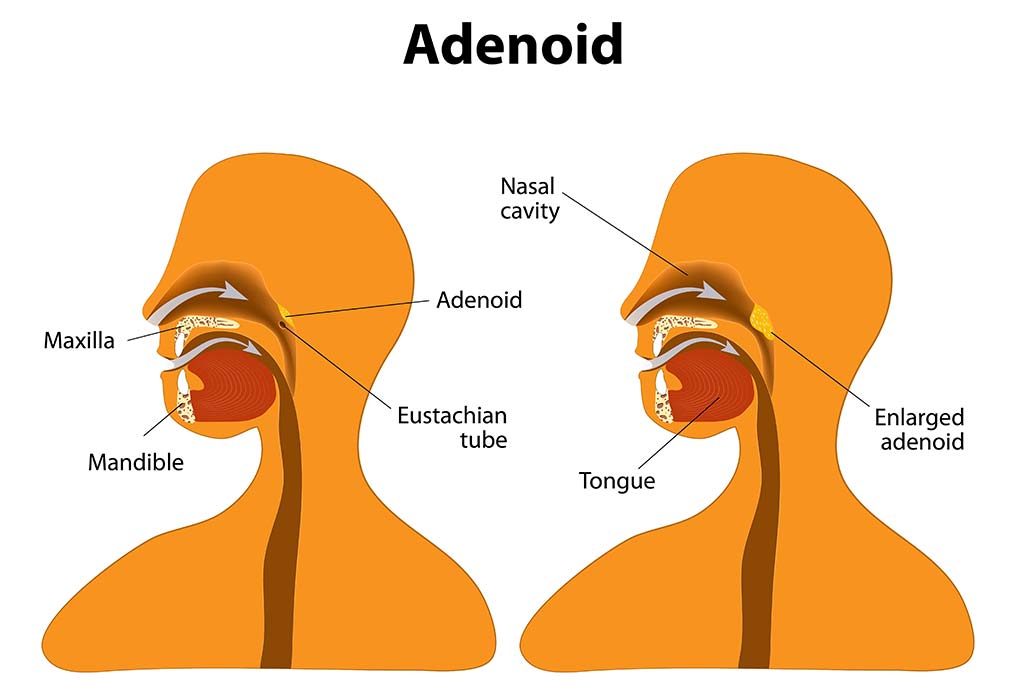 Adenoid yang membesar
