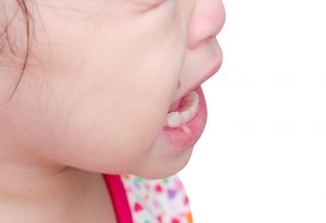 Bisul Mulut ( Sariawan ) pada Bayi &amp; Anak