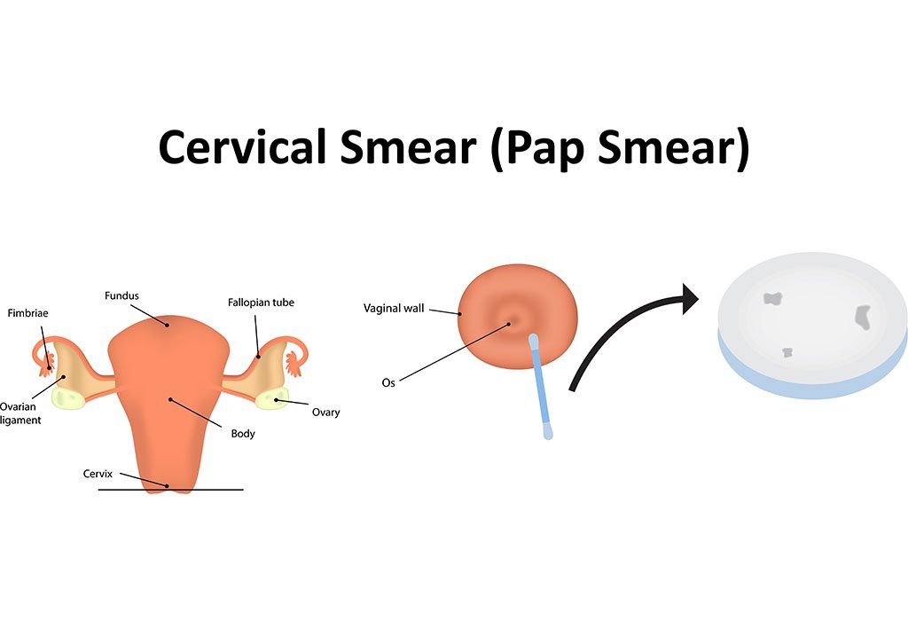 Bagaimana Tes Pap Smear Dilakukan?