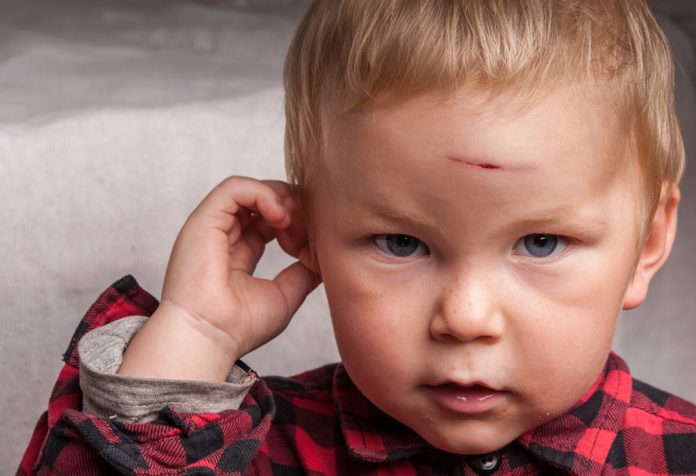 Cedera Kepala pada Anak