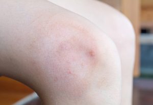 Sakit Lutut pada Anak