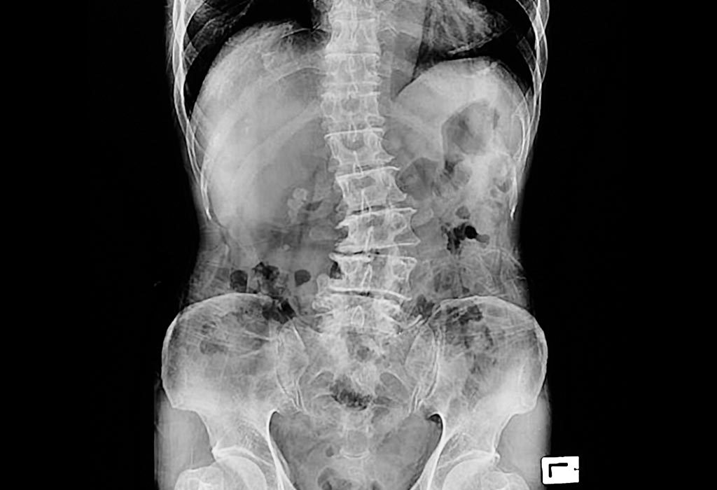X-ray untuk memeriksa skoliosis