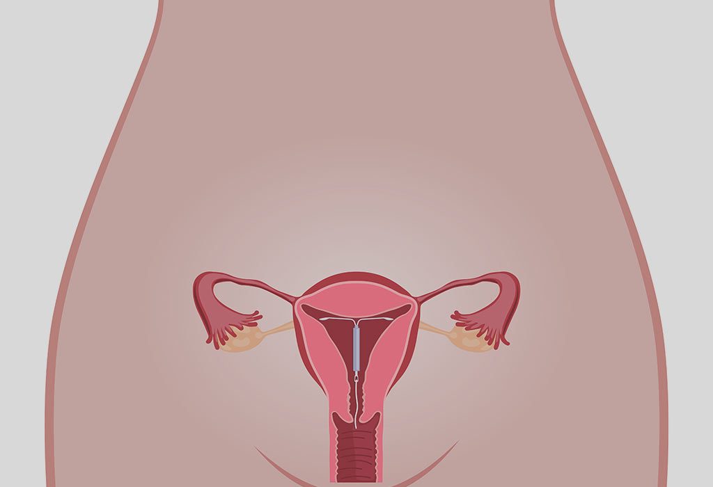 IUD di dalam rahim wanita