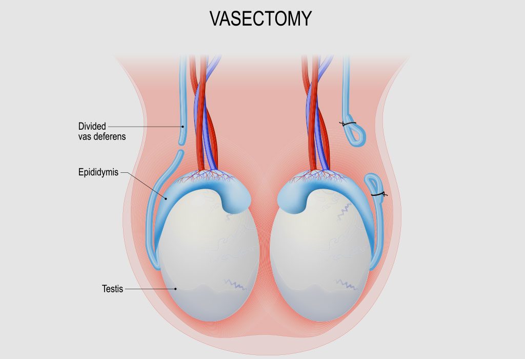 Vasektomi