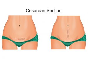 Persalinan Caesar – Semua Tentang Kelahiran C-Section