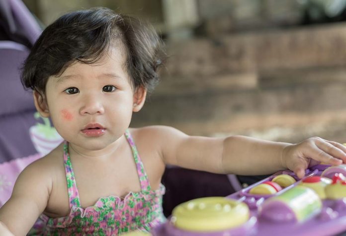 Pengobatan Rumahan untuk Menghilangkan Bercak Putih di Wajah Bayi dan Anak