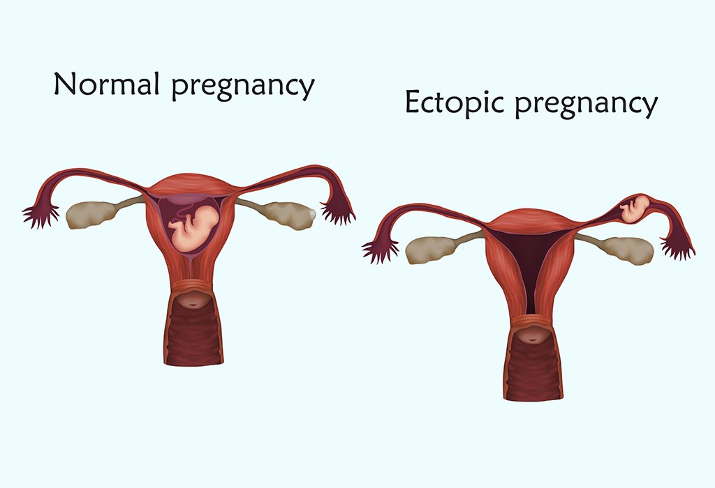 Kehamilan ektopik