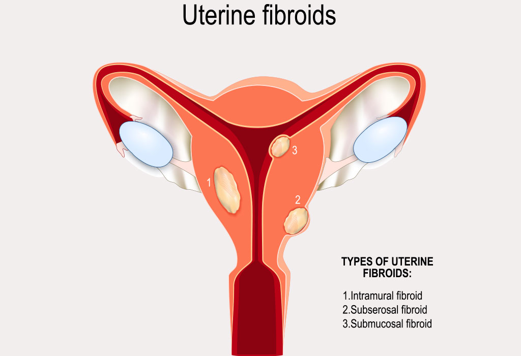 Fibroid rahim