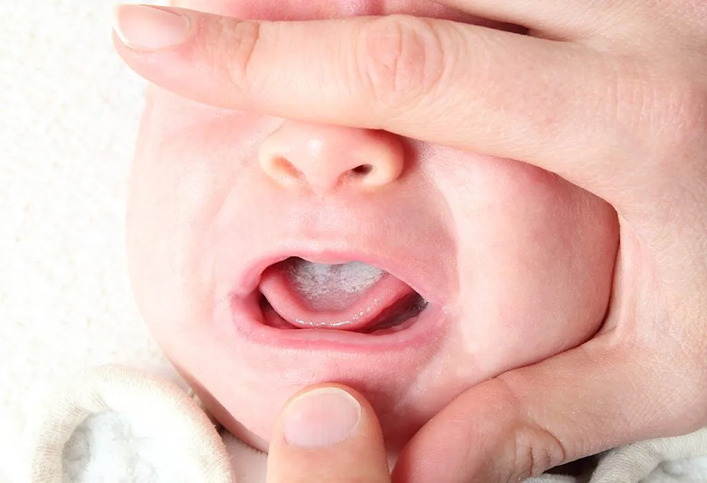 Sariawan Oral pada Bayi