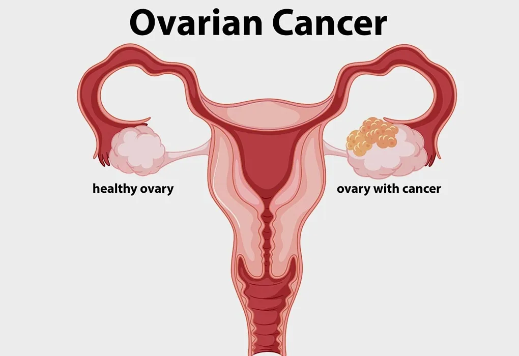 Kanker ovarium