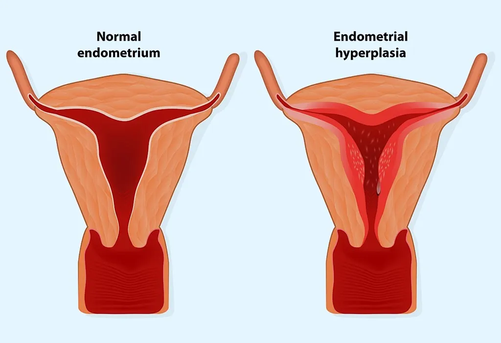 Berapa Banyak Ketebalan Endometrium yang Terlalu Banyak?
