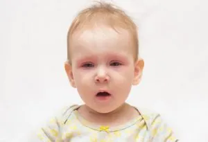 Penyebab Sindrom Pipi Ditampar pada Bayi dan Balita