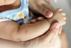 Gigitan nyamuk di lengan anak