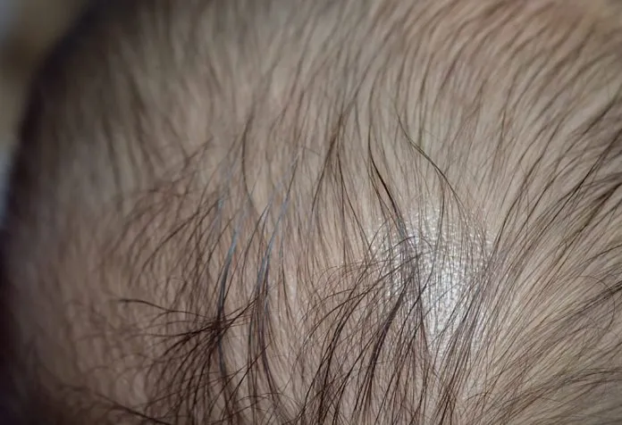 Alopecia Areata pada Anak