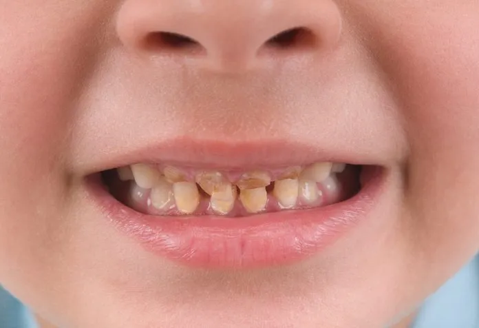 Kuning dan Perubahan Warna Gigi pada Anak-anak