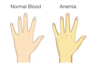 Kulit kuning adalah salah satu gejala paling umum dari Anemia