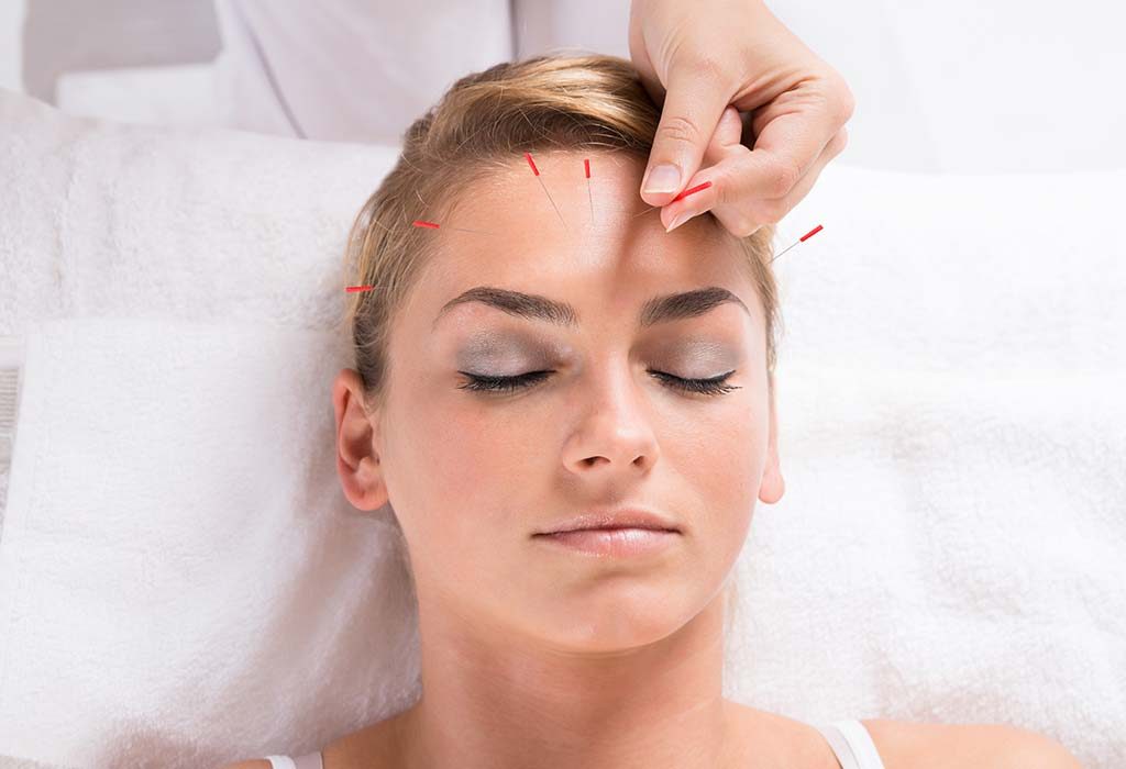 Terapi Akupunktur