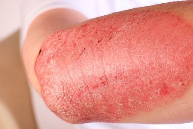 Bintik merah pada kulit: 18 penyebab, foto dan apa yang harus dilakukan
