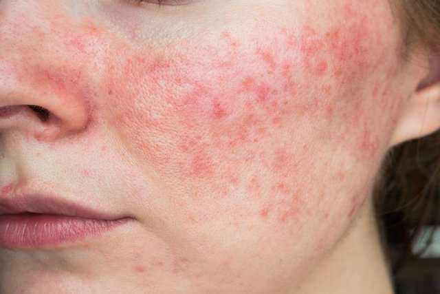 Bintik merah pada kulit: 18 penyebab, foto dan apa yang harus dilakukan