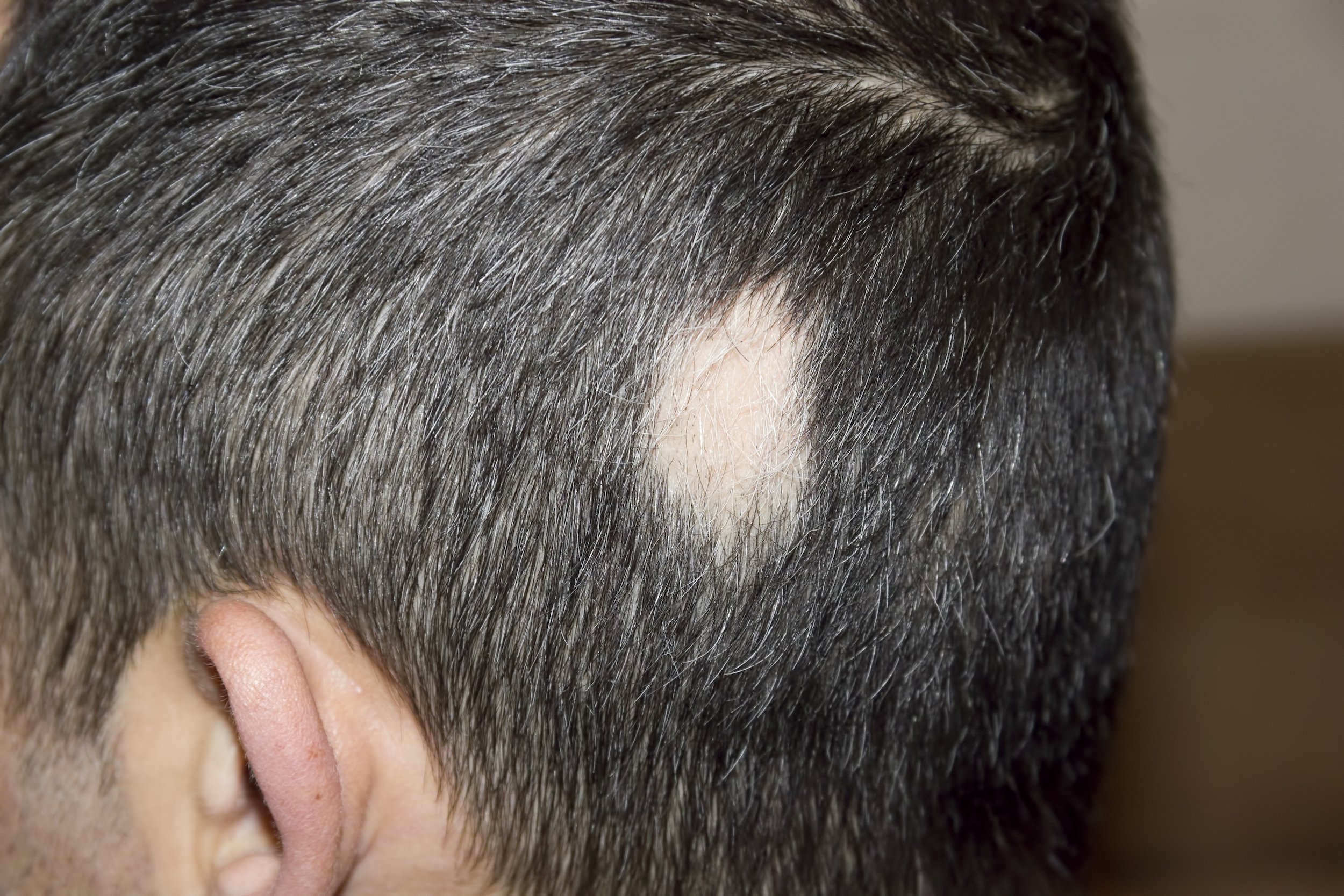 Alopecia areata: apa itu, gejala, penyebab dan pengobatan_0