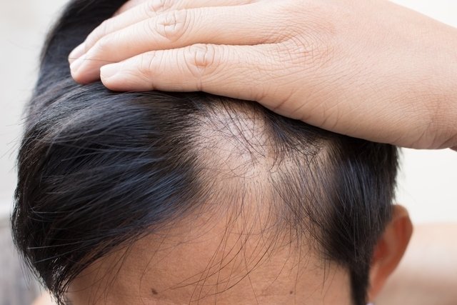 Alopecia: apa itu, gejala, penyebab dan pengobatan_0