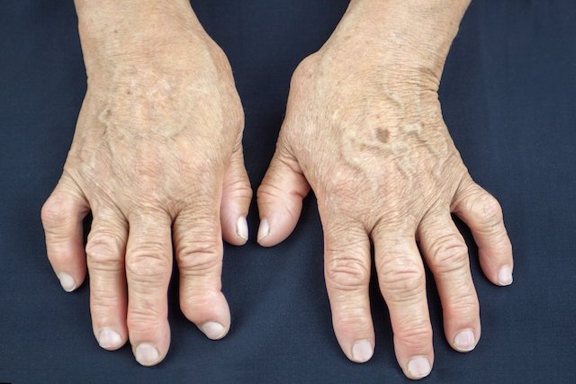 Psoriatic arthritis: apa itu, gejala, jenis dan pengobatan_0