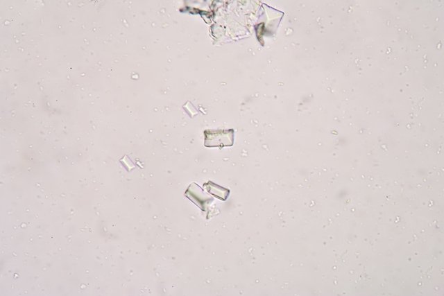 Kristal dalam urin: apa itu, gejala, penyebab dan jenisnya_0