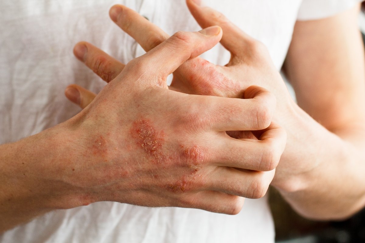 Dermatitis nummular: apa itu, gejala, penyebab dan pengobatan_0