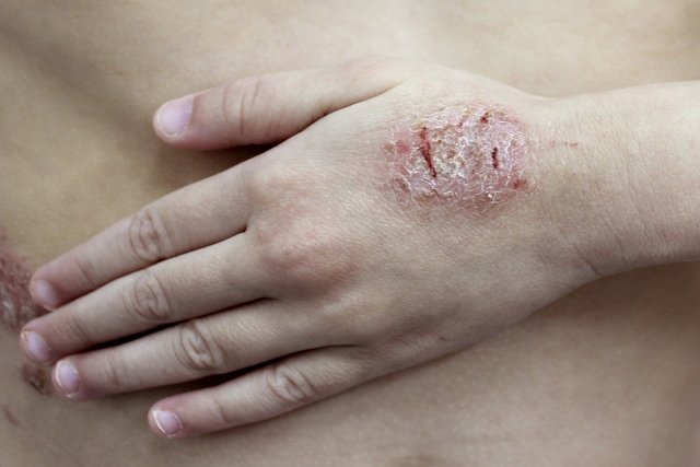 Dermatitis: apa itu, gejala, jenis, penyebab dan pengobatan (dengan foto)