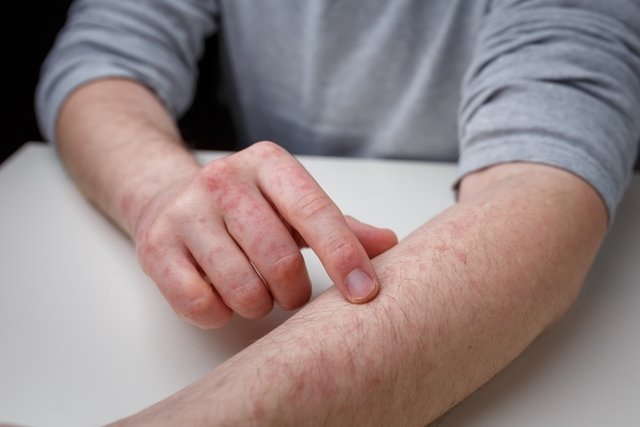 Dermatitis: apa itu, gejala, jenis, penyebab dan pengobatan (dengan foto)