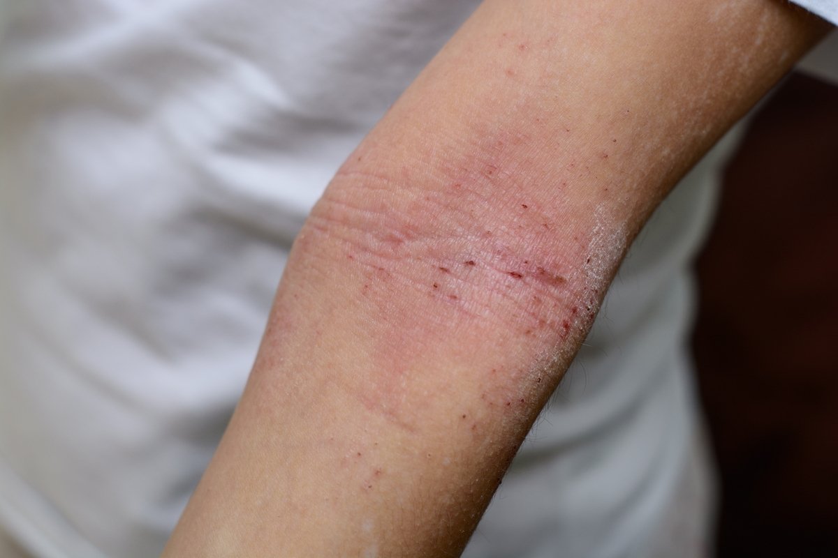 Dermatitis: apa itu, gejala, jenis, penyebab dan pengobatan (dengan foto)_0