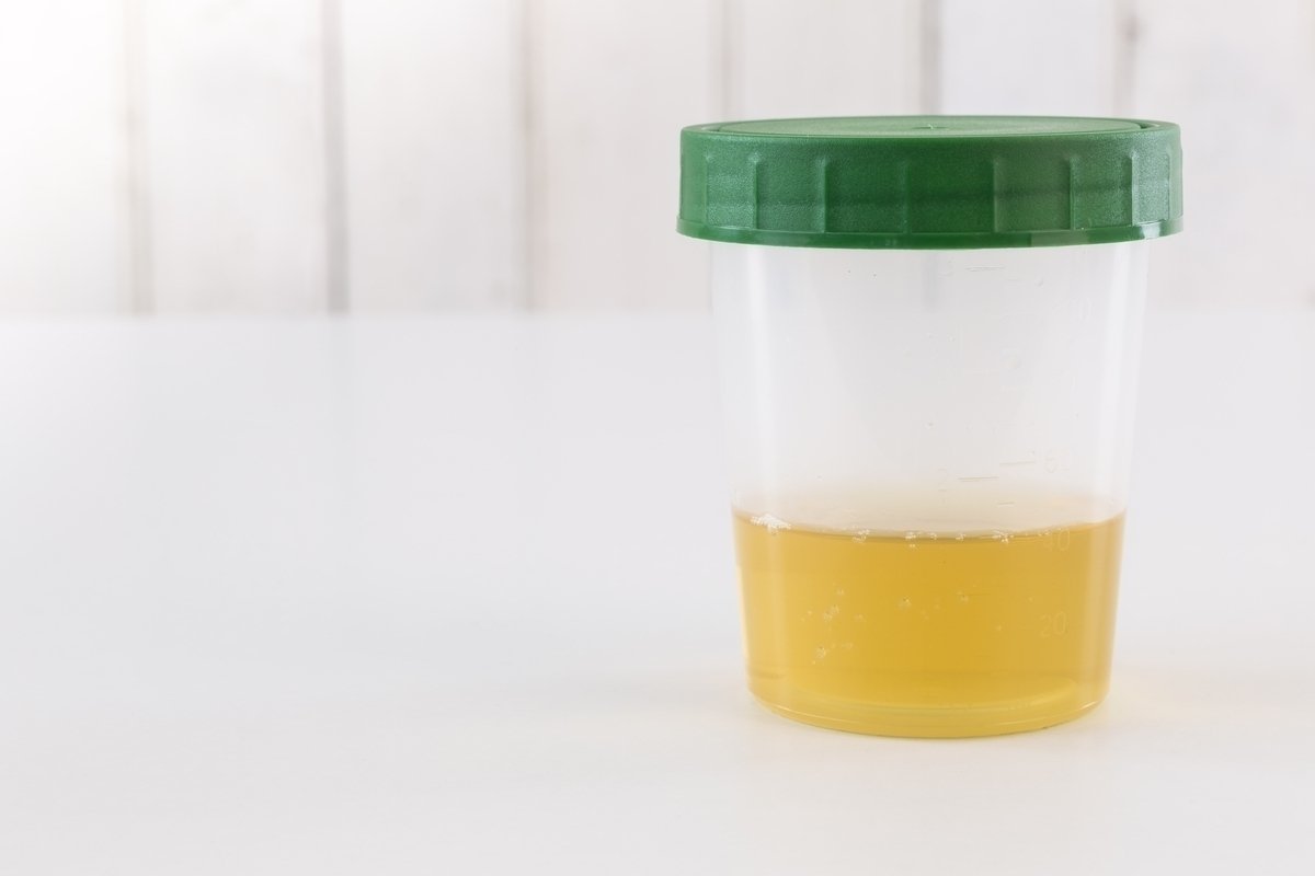 Leukosit tinggi dalam urin: apa itu (dan apa yang harus dilakukan)_0