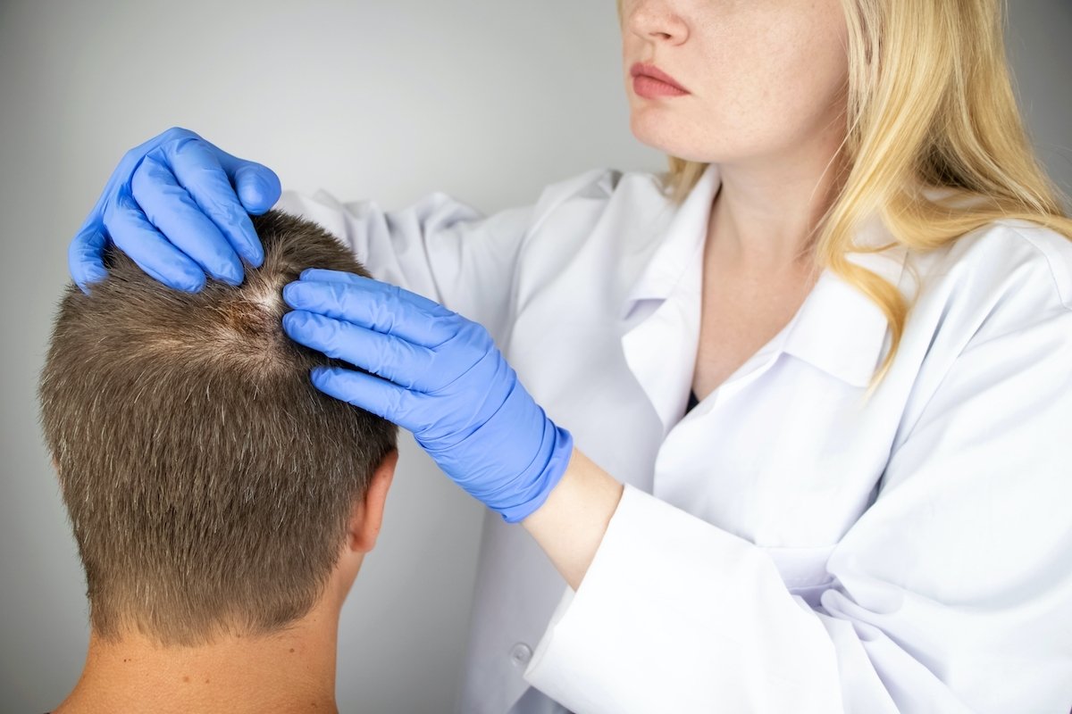 Kurap di kulit kepala: gejala, penyebab dan pengobatan_0