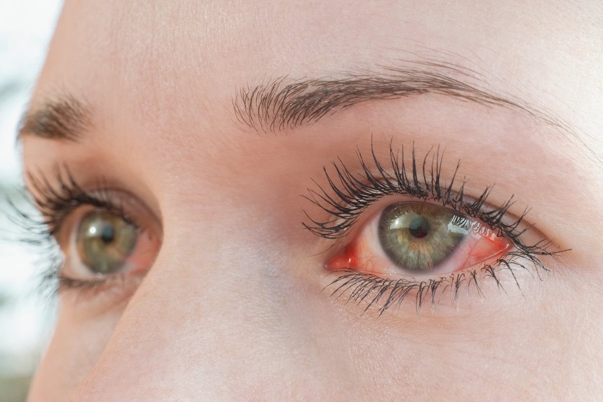 Mata merah: 13 penyebab umum dan apa yang harus dilakukan_0