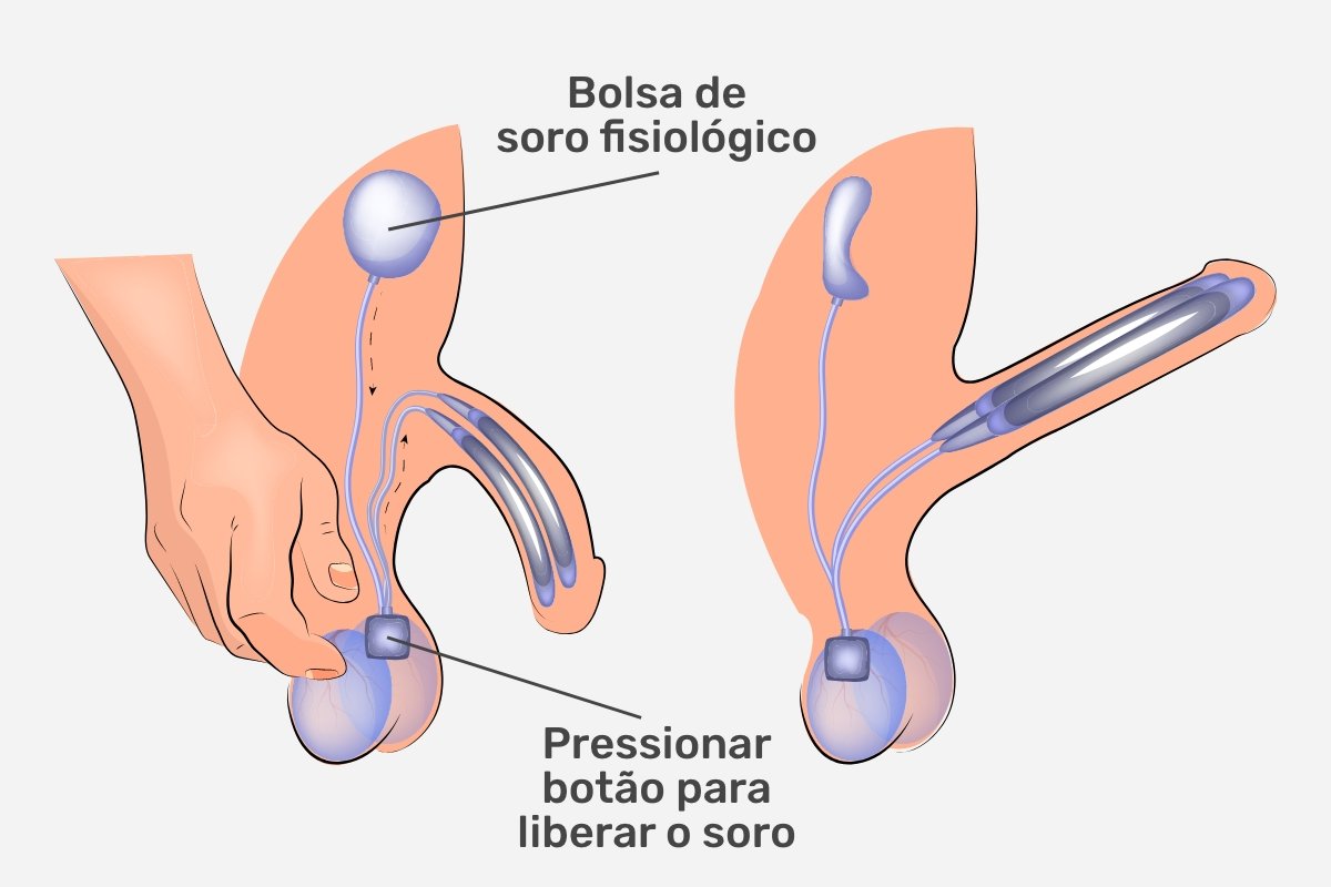 Prostesis penis: apa itu, kapan diindikasikan, jenis dan pembedahan_0
