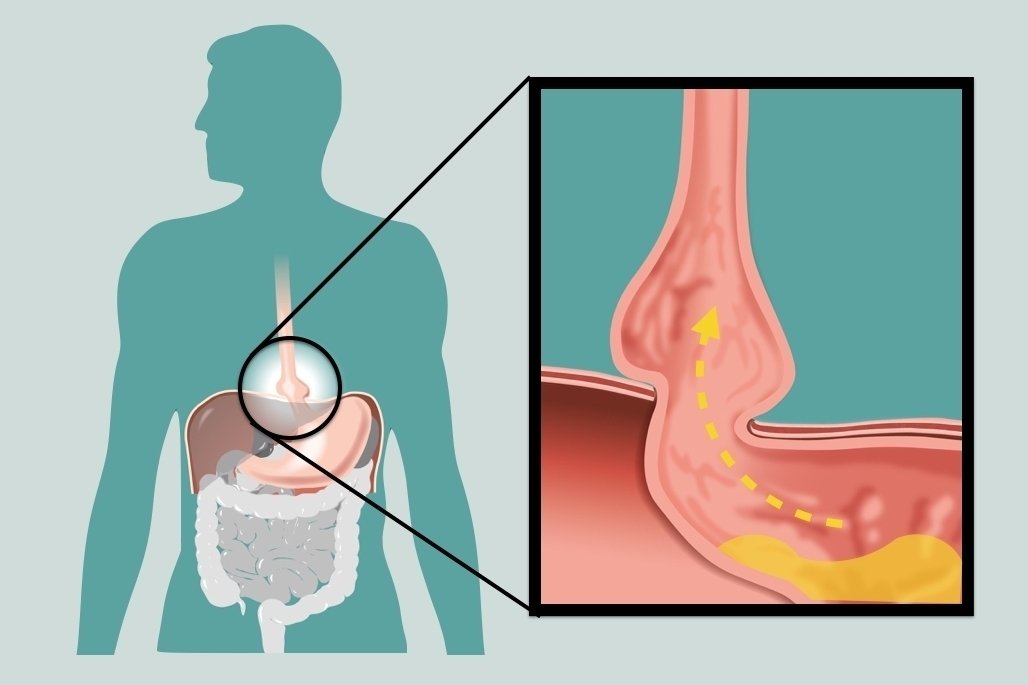 Gastroesophageal reflux: apa itu, gejala, penyebab dan pengobatan_0