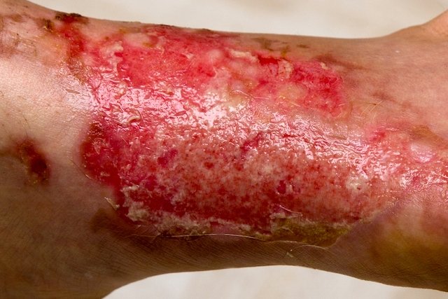 Sindrom kulit melepuh: apa itu, gejala, penyebab dan pengobatan_0