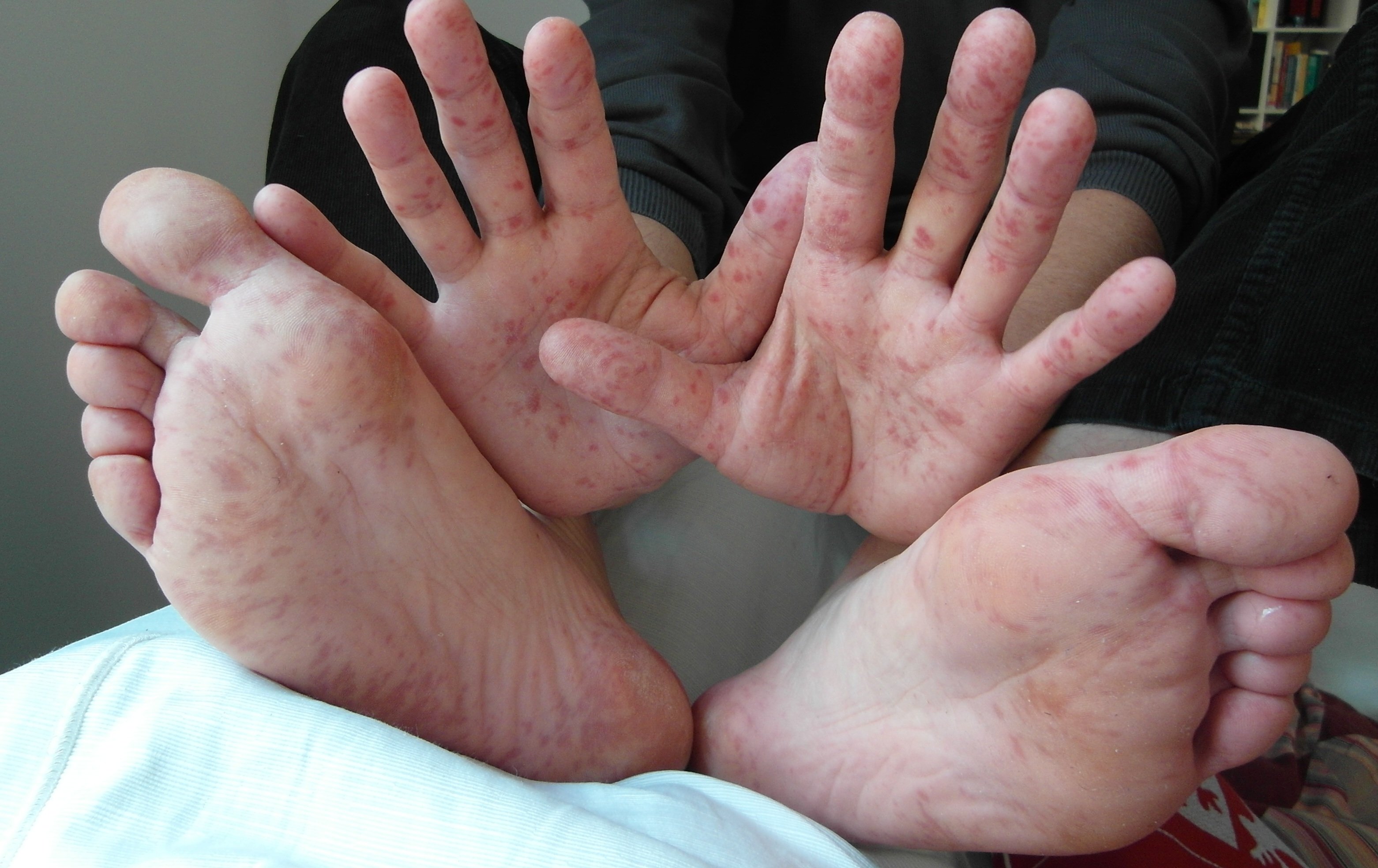 Sindrom tangan-kaki-mulut: apa itu, gejala, penularan dan pengobatan_0