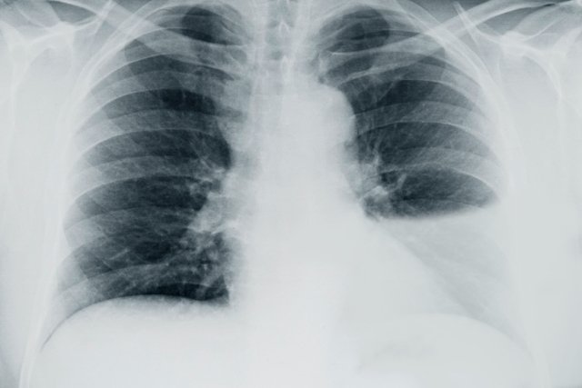 9 gejala air di paru-paru dan cara memastikannya_0