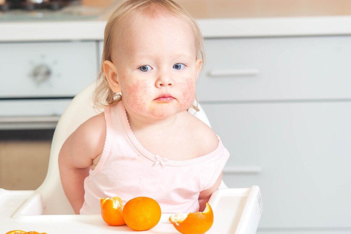Alergi makanan bayi: gejala, penyebab dan apa yang harus dilakukan_0