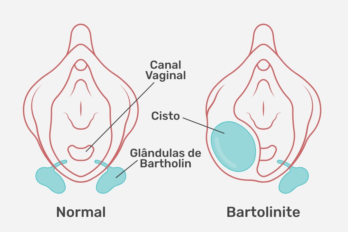 Bartholinitis: apa itu, gejala, penyebab dan pengobatan_0