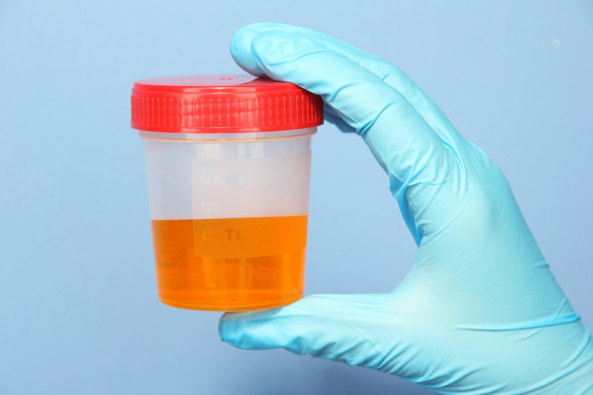 Bilirubin dalam urin: apa itu dan apa yang harus dilakukan_0