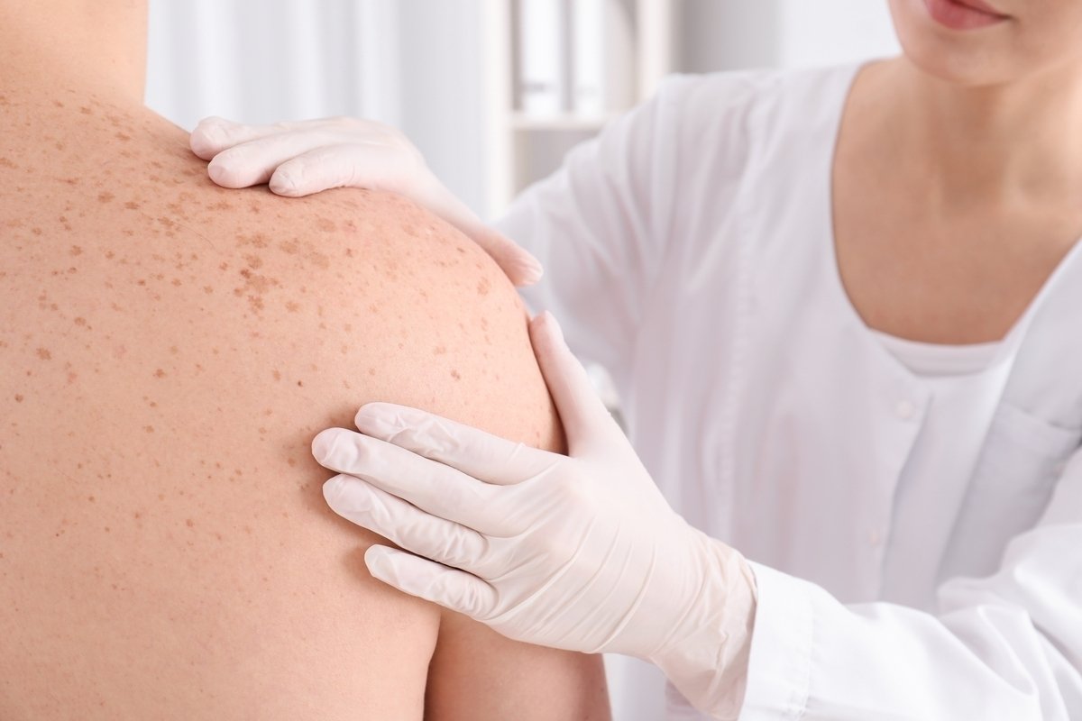 Biopsi kulit: bagaimana dilakukan, jenis dan kapan diindikasikan_0
