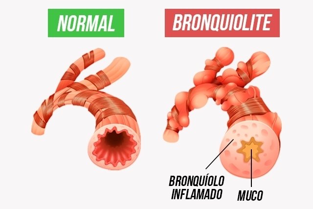 Bronchiolitis: apa itu, gejala, penyebab dan pengobatan_0